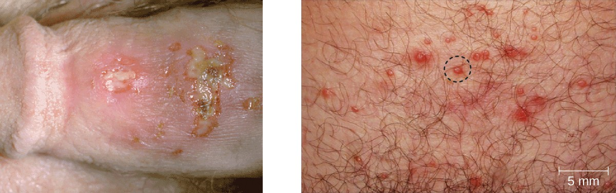 Genital herpes is typically characterized by lesions on the genitals (left), but lesions can also appear elsewhere on the skin or mucous membranes (right). The lesions can be large and painful or small and easily overlooked.