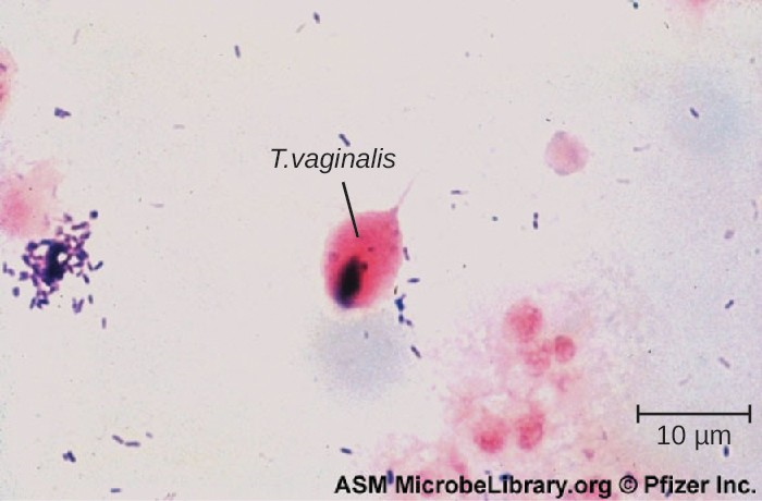 Trichomonas vaginalis is visible in this Gram stained specimen.