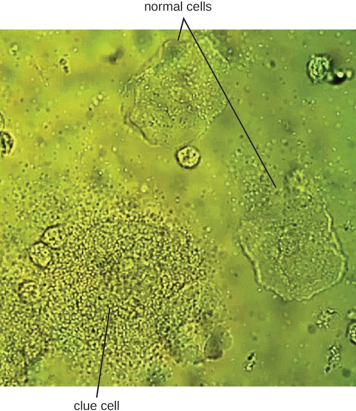 In this vaginal smear, the cell at the lower left is a clue cell with a unique appearance caused by the presence of bacteria on the cell. The cell on the right is a normal cell.