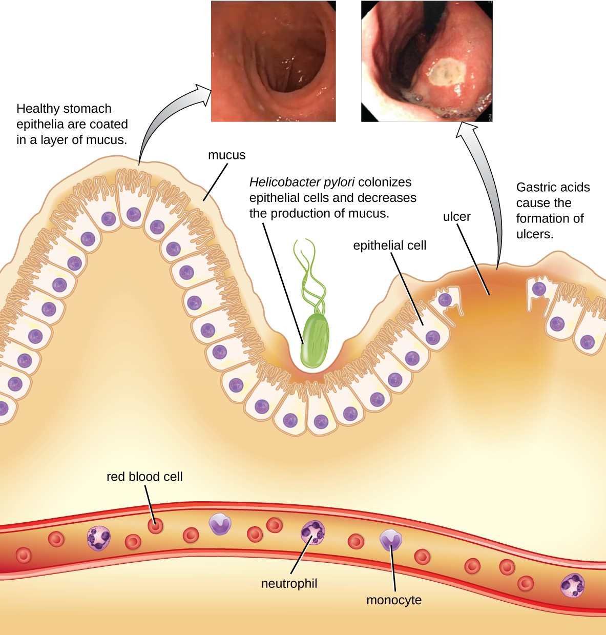 19 3 Bacterial Infections Of The Gastrointestinal Tract Allied Health   Fig. 24.20 