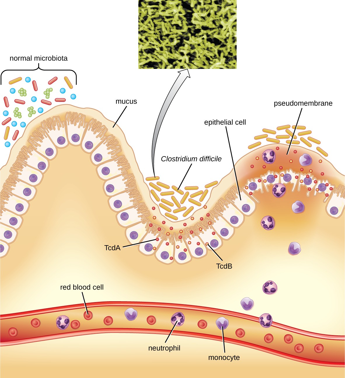 Clostridium difficile is able to colonize the mucous membrane of the colon when the normal microbiota is disrupted. The toxins TcdA and TcdB trigger an immune response, with neutrophils and monocytes migrating from the bloodstream to the site of infection. Over time, inflammation and dead cells contribute to the development of a pseudomembrane.