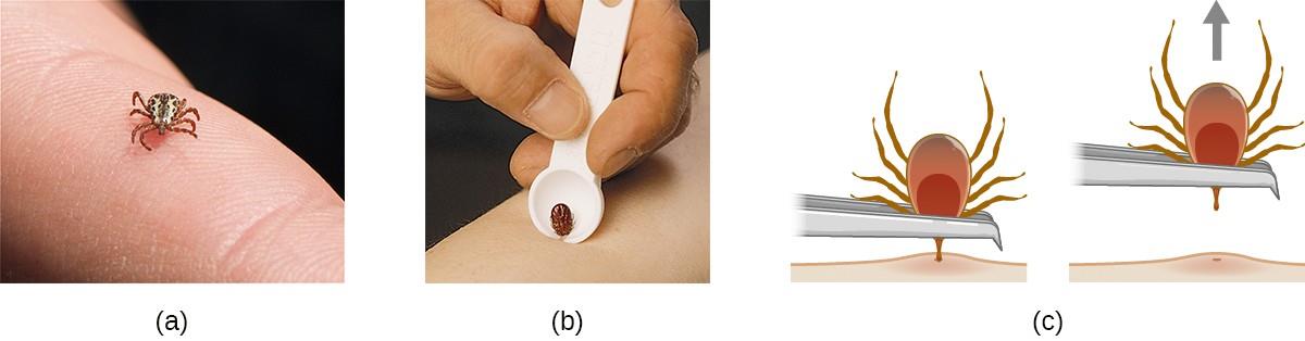 (a) This black-legged tick, also known as the deer tick, has not yet attached to the skin. (b) A notched tick extractor can be used for removal. (c) To remove an attached tick with fine-tipped tweezers, pull gently on the mouth parts until the tick releases its hold on the skin. Avoid squeezing the tick’s body, because this could release pathogens and thus increase the risk of contracting Lyme disease.